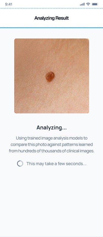 Analyzing a lesion photo in the SkinAware app